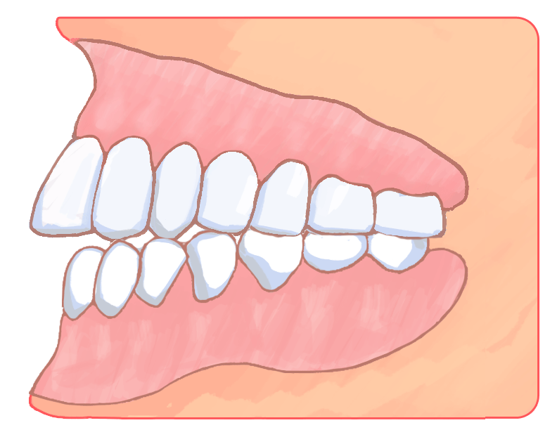 上下顎前突（じょうかがくぜんとつ）