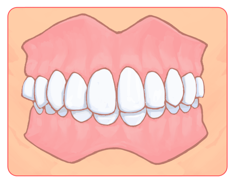 下の歯が見えない（過蓋咬合・かがいこうごう）