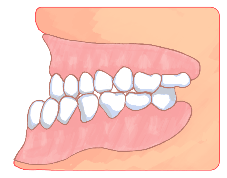 下の歯が前に出ている（受け口）