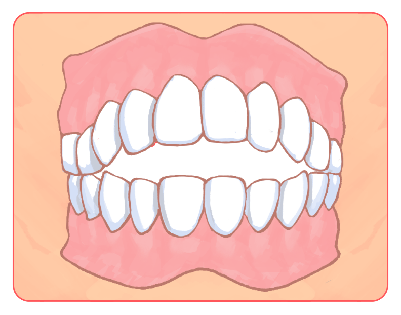 前歯で噛めない（開咬・かいこう）