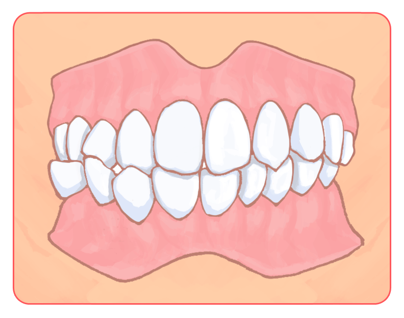 交叉咬合（こうさこうごう）