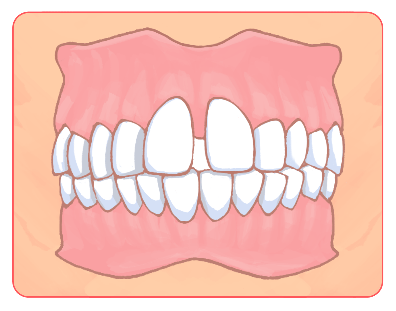 歯と歯の間の隙間がある（すきっ歯）