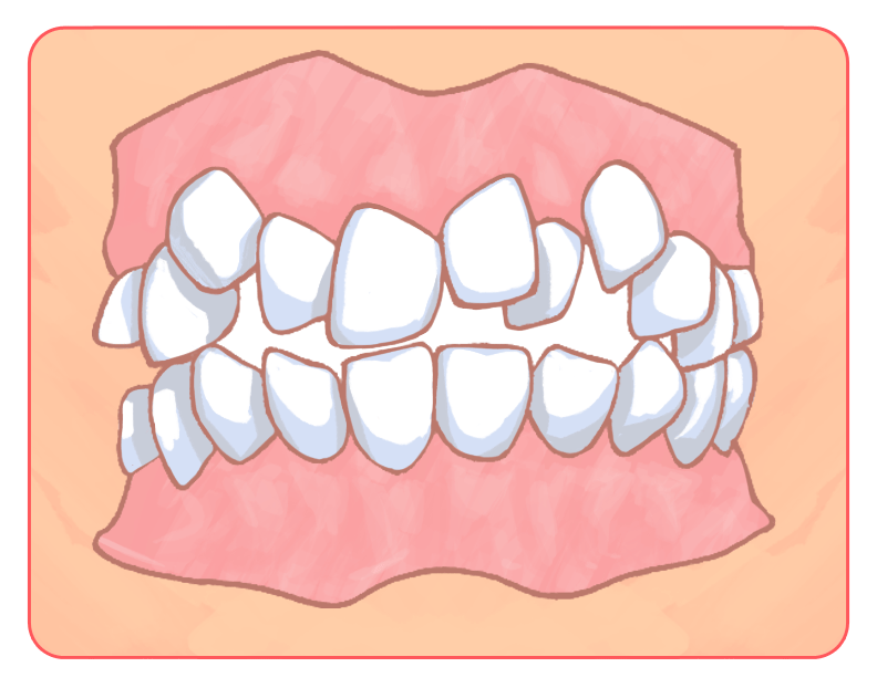 歯がデコボコ（叢生・そうせい）